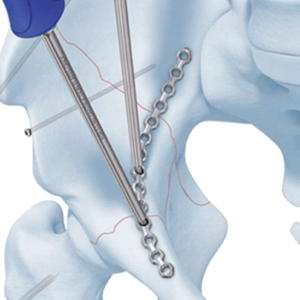 Pelvis – Sistema de osteosíntesis para reconstrucción pélvica y acetabular