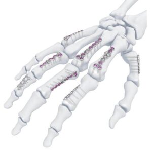 Compact Hand – Sistema de osteosíntesis para mano y muñeca