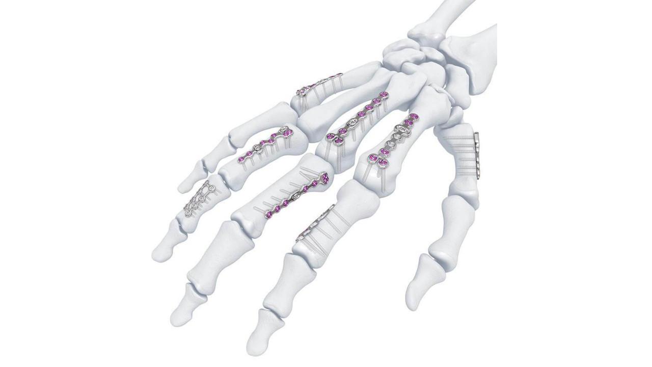 Compact Hand – Système d’ostéosynthèse pour la main et le poignet