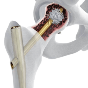 TFN-A – Sistema de enclavado intramedular para fémur proximal